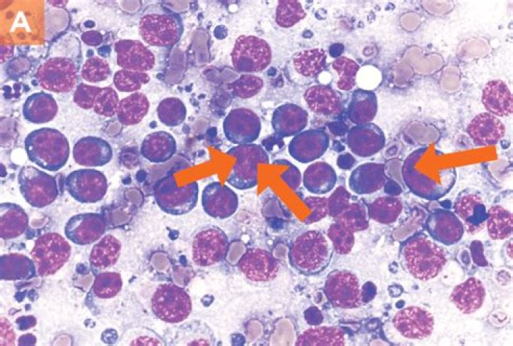 Are lymphosarcoma and lymphoma the same?