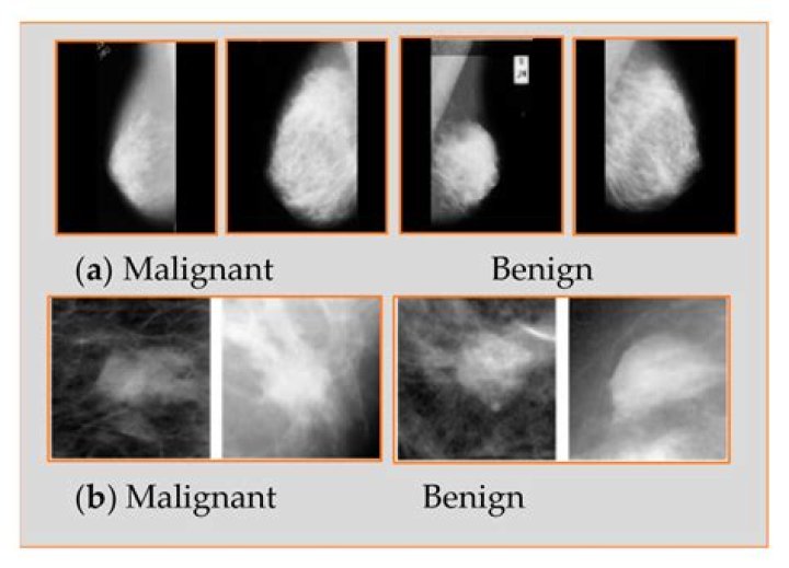 Are malignant breast tumors painful?