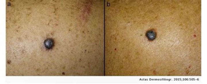 Are nodular melanomas always raised?