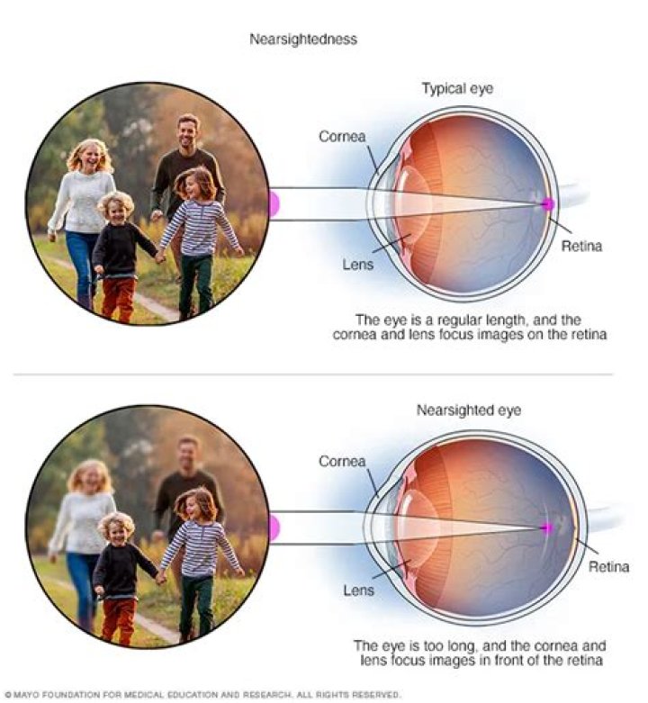 Are you born nearsighted?