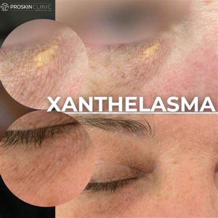 At home treatment for xanthelasma?
