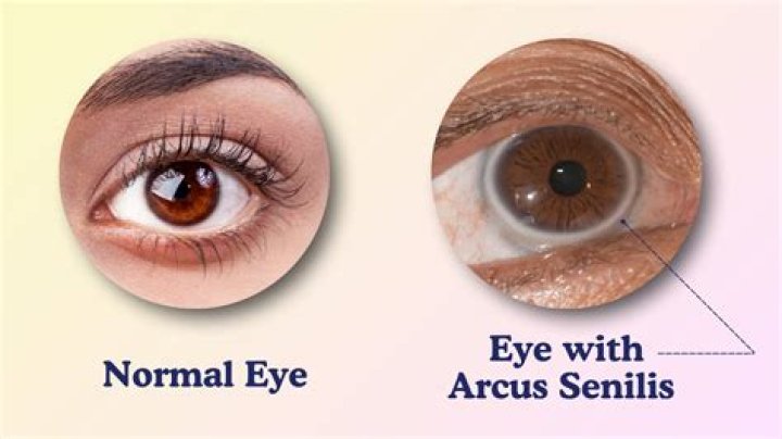 At what age does arcus senilis start?