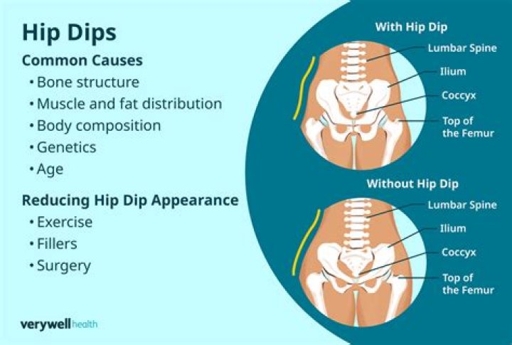 Can bbl fix hip dips?