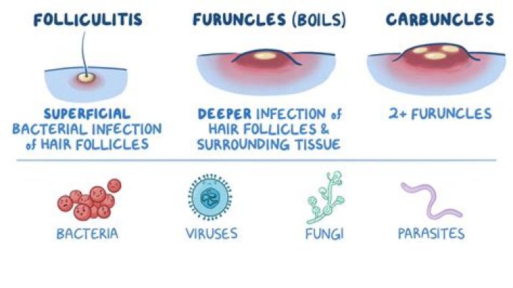 Can carbuncle cause fever?
