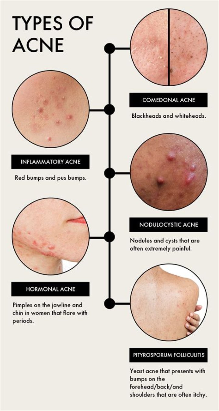 Can cover up cause acne?