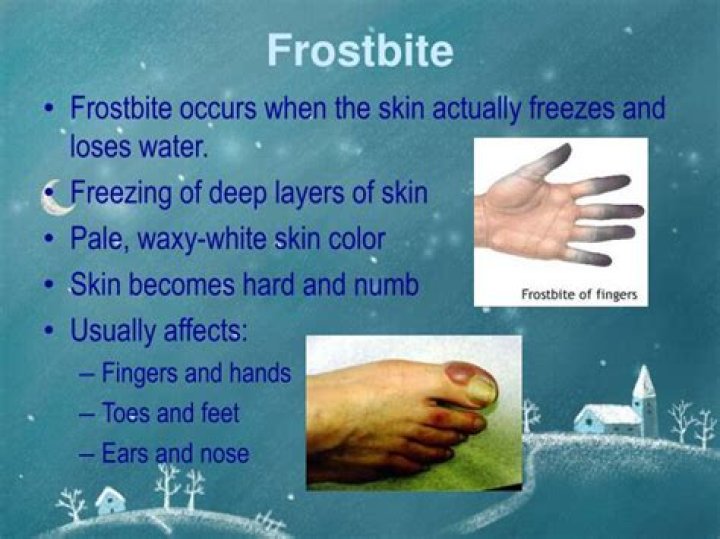 Can frostbite kill you?