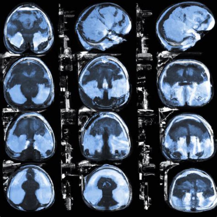 Can mri show old brain injury?