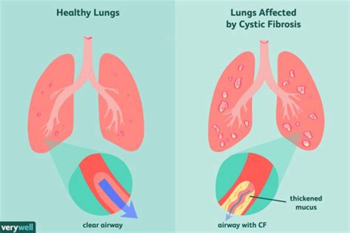 Can you die from cystic fibrosis?