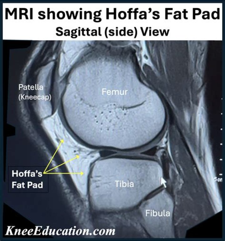 Can you run with hoffa syndrome?