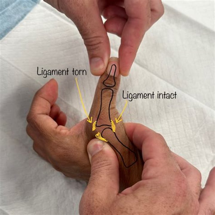 Could someone sprain a ligament?