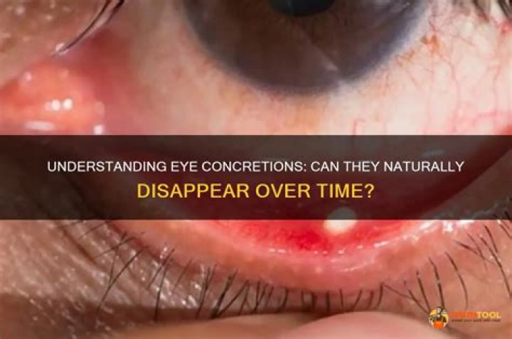 Do eye concretions go away?