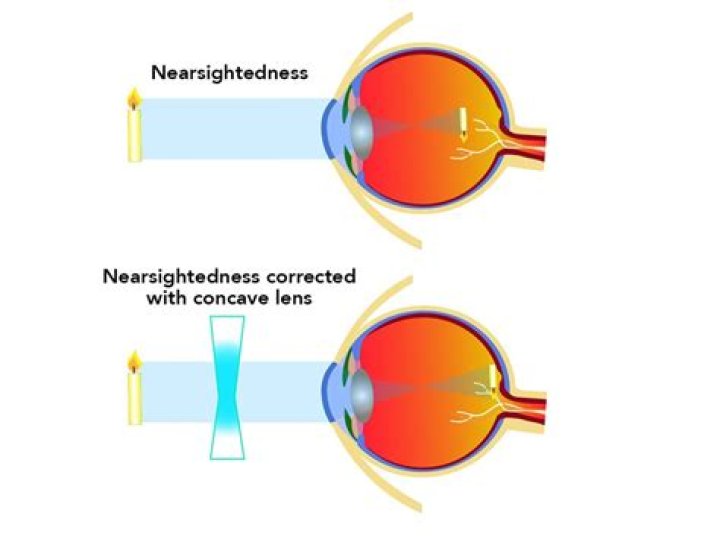 Do i have short sightedness?