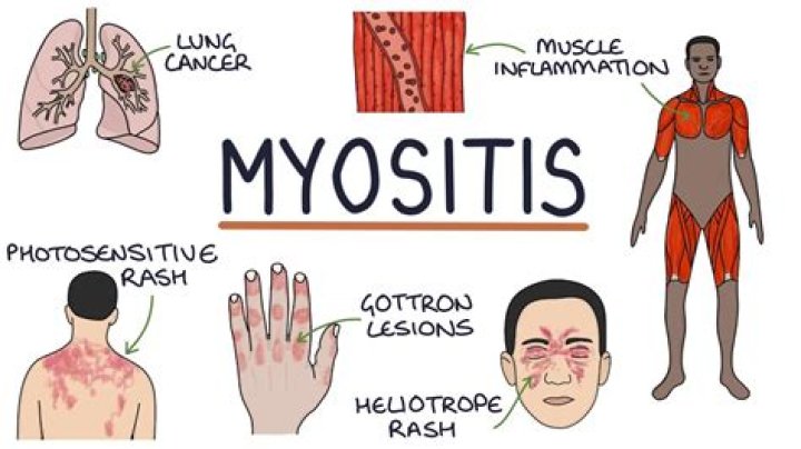 Do statins cause myositis?
