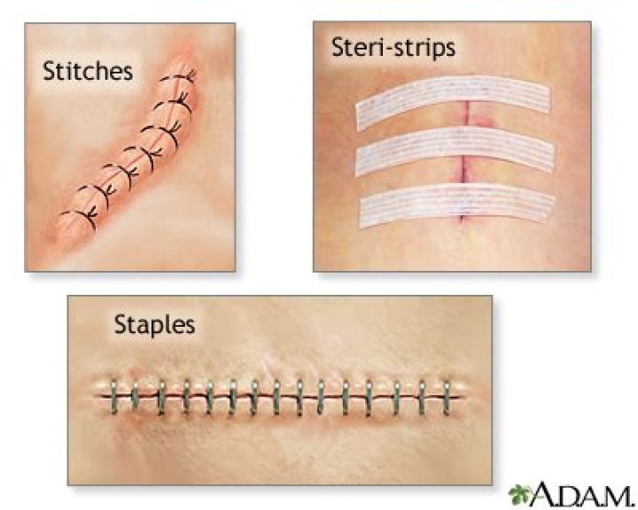 Do steri strips dissolve?