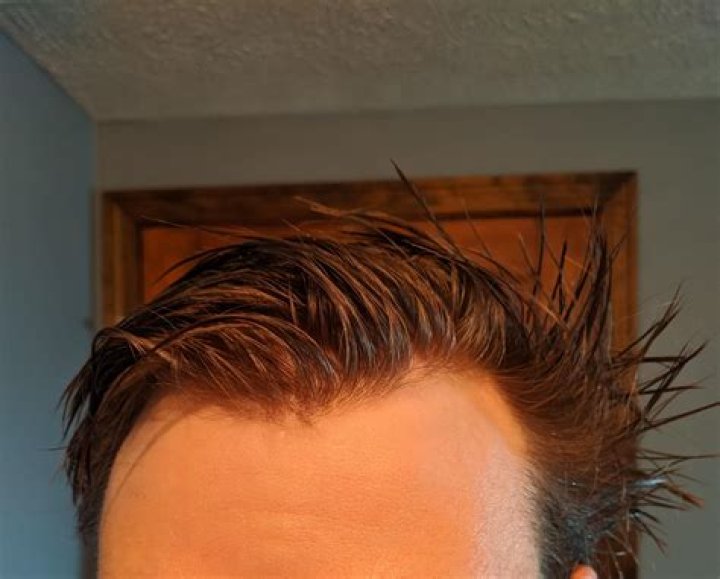 Do widows peaks grow back?