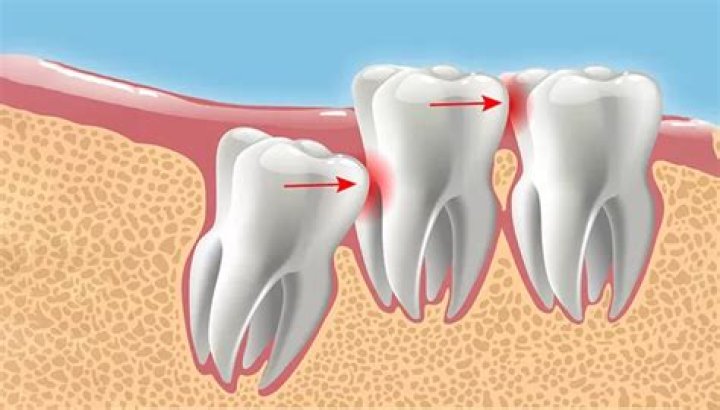 Do wisdom teeth stop growing?