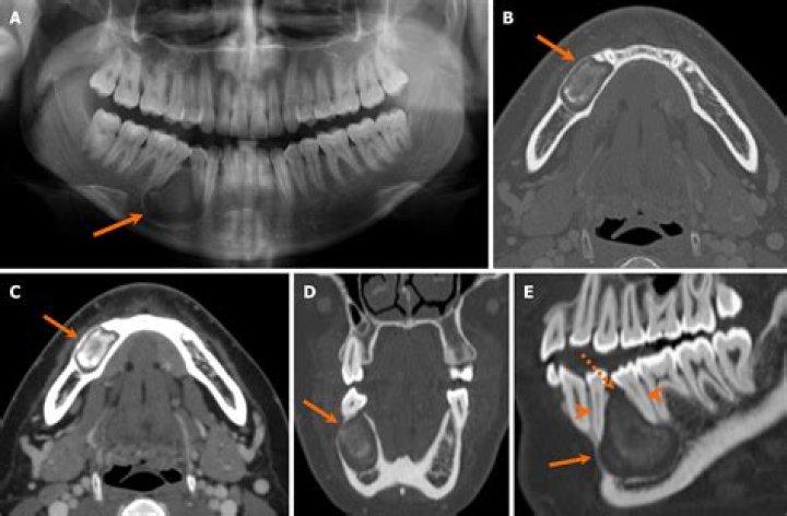 Does ameloblastoma cause root resorption?