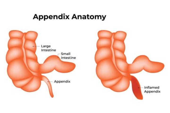 Does appendix show up on ct scan?