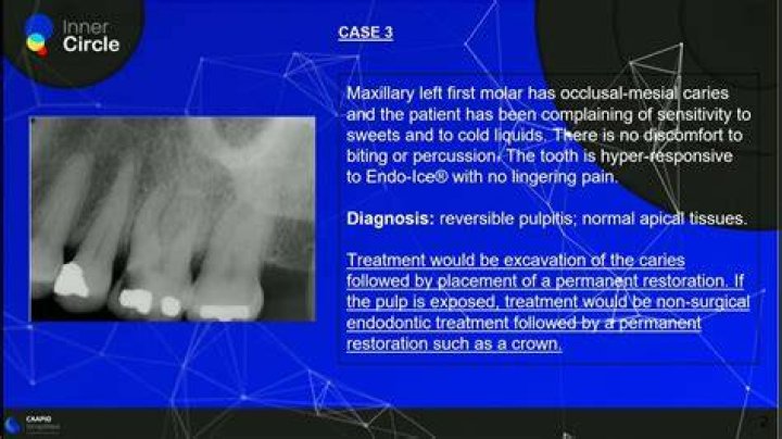 Does pulpitis show up on an x ray?