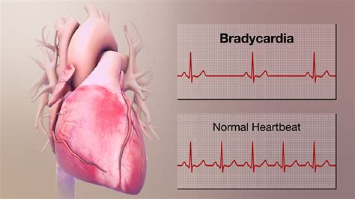 Does versed make you bradycardic?