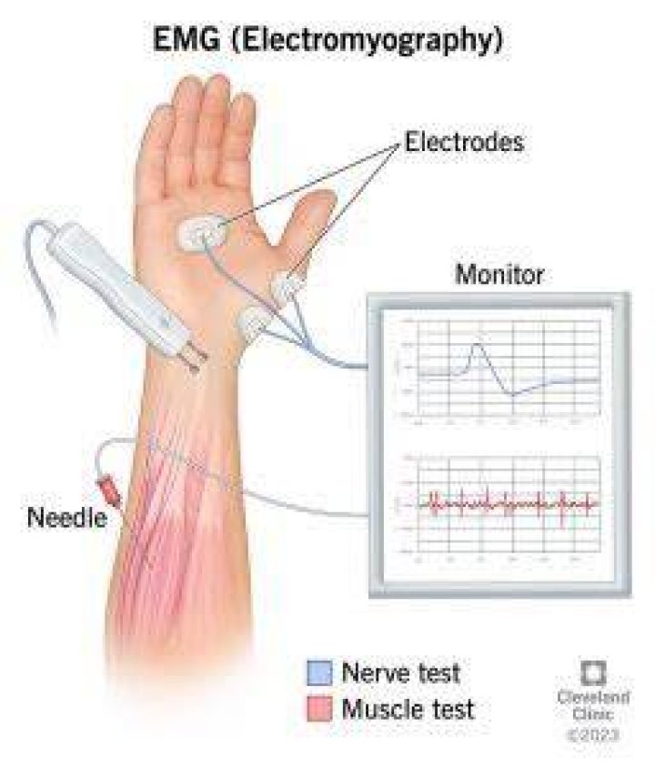 During electromyography which parameter you measured?