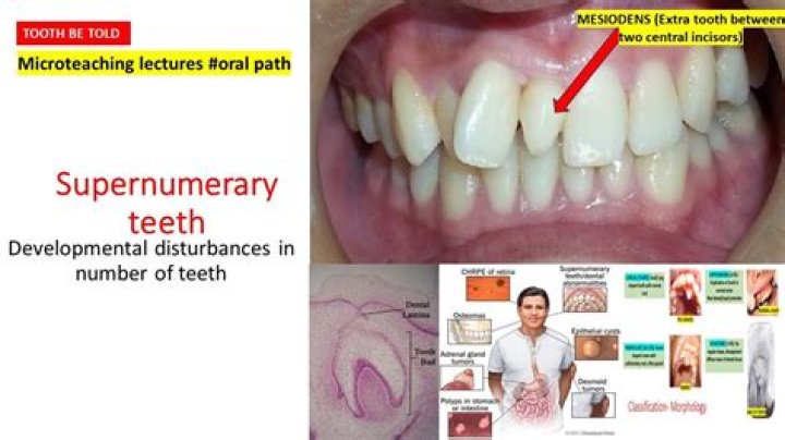 How common are supernumerary teeth?