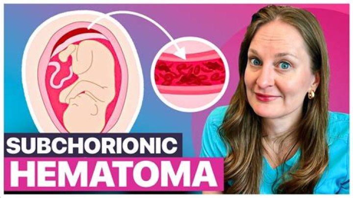 How does subchorionic hematoma go away?