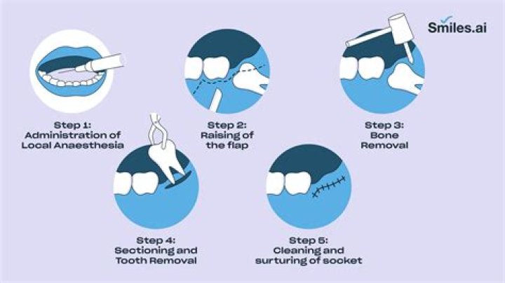 How is anesthesia given for wisdom teeth removal?