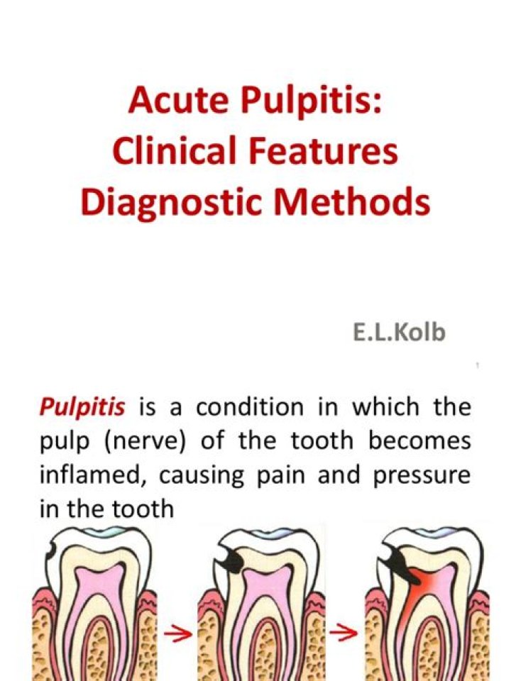 How is pulpitis diagnosis?