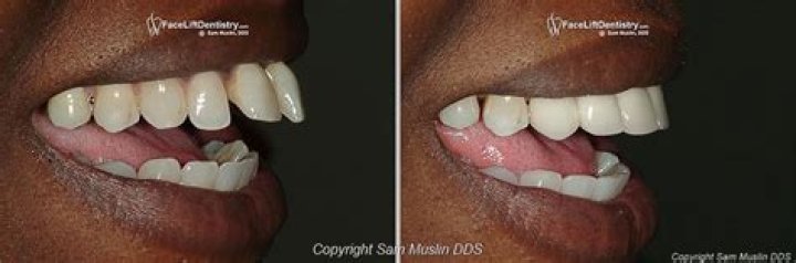 How to fix buck teeth?
