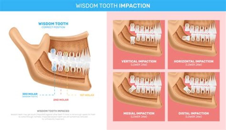 How wisdom teeth are taken out?