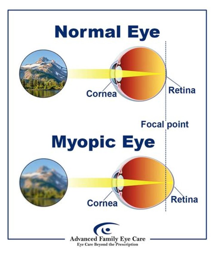 In myopia image is formed?