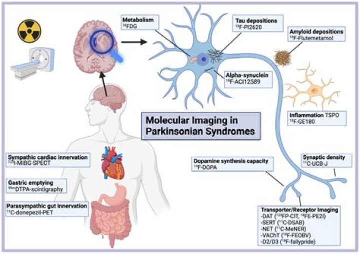 In parkinsonism the tremors muscle rigidity?