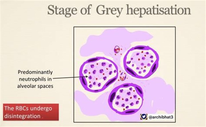 In the stage of grey hepatisation which of the following is a finding?