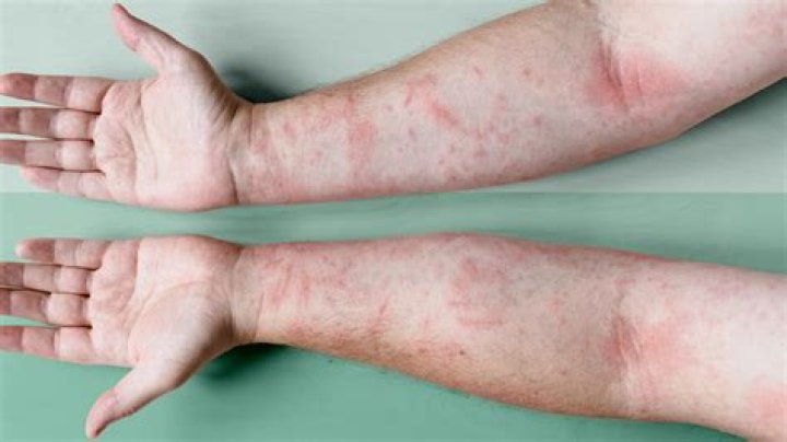 Is atopic dermatitis the same as eczema?