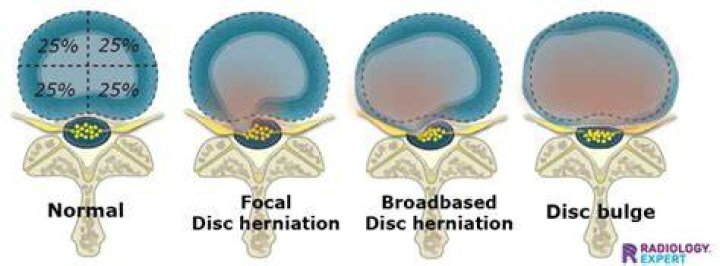 Is broad based disc bulge painful?