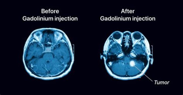 Is gadolinium used in ct scans?
