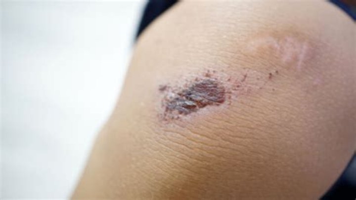 Is scabbing a sign of healing?
