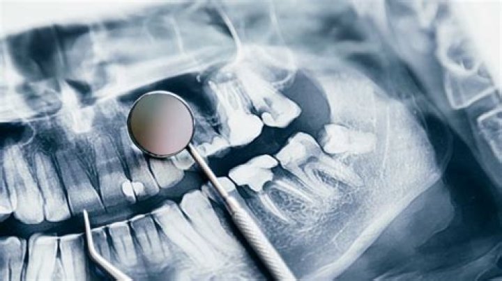 Was ist amalgam füllung?
