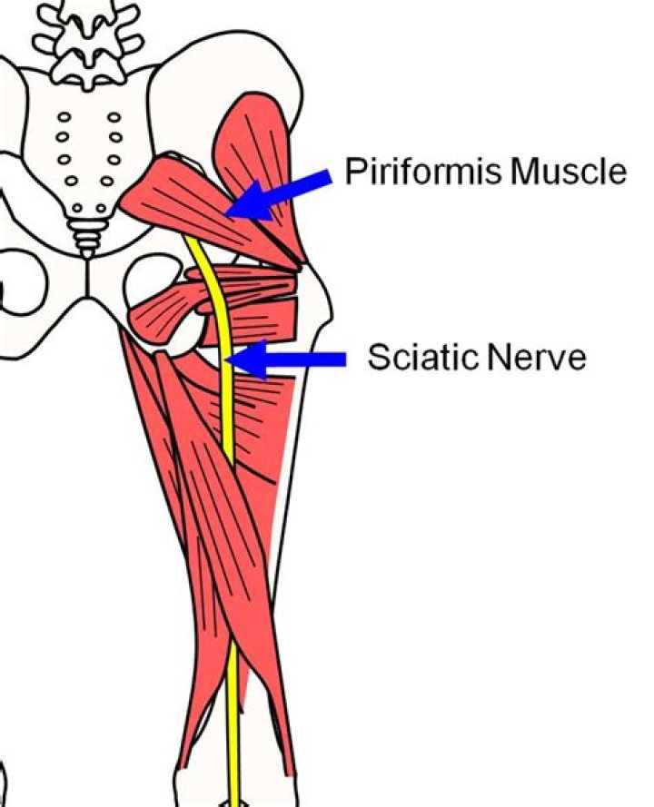 What causes a tight piriformis muscle?