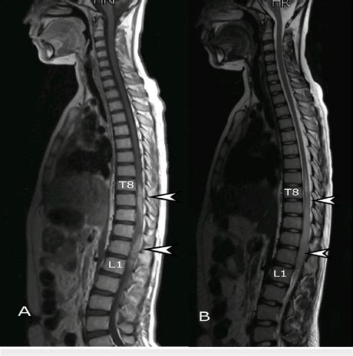What does the medical term enostosis mean?