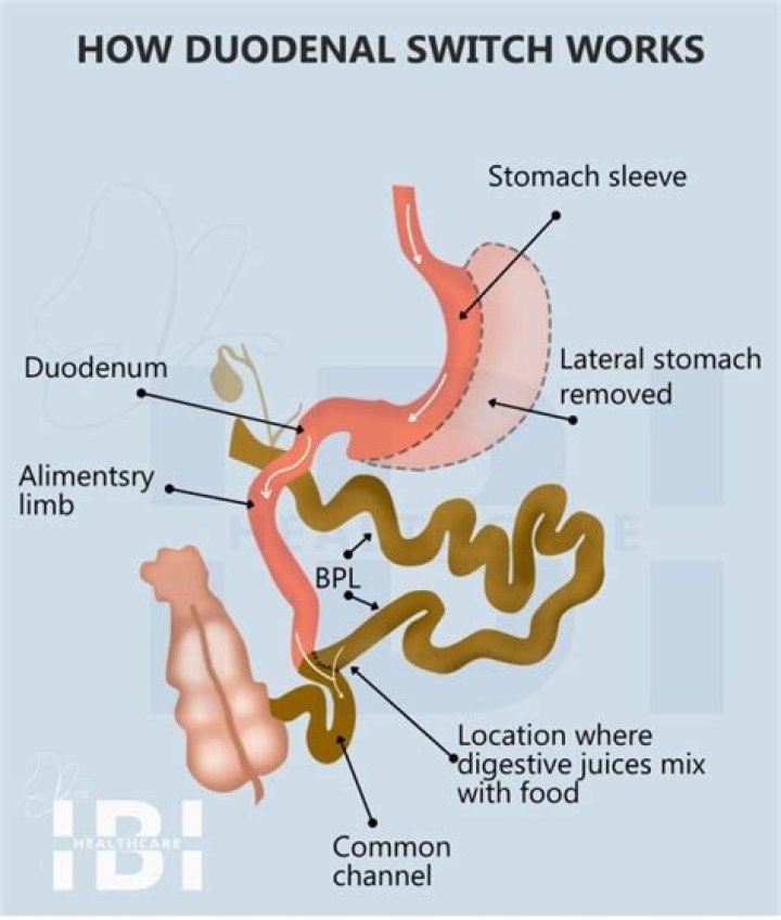 What duodenal switch surgery?