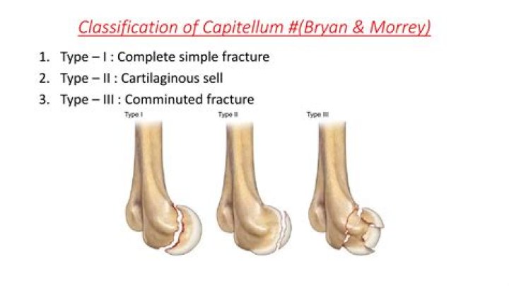What is a capitellum fracture?