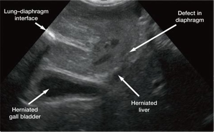 What is abdominal ultrasonography?