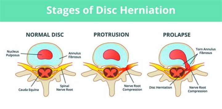 What is central disc protrusion?