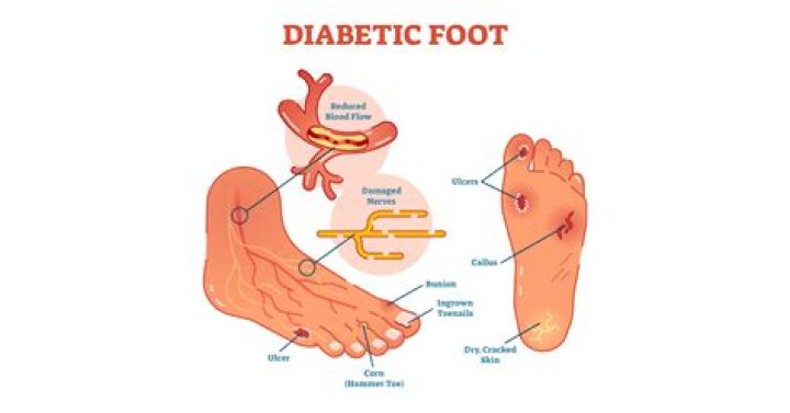 What is diabetic foot?