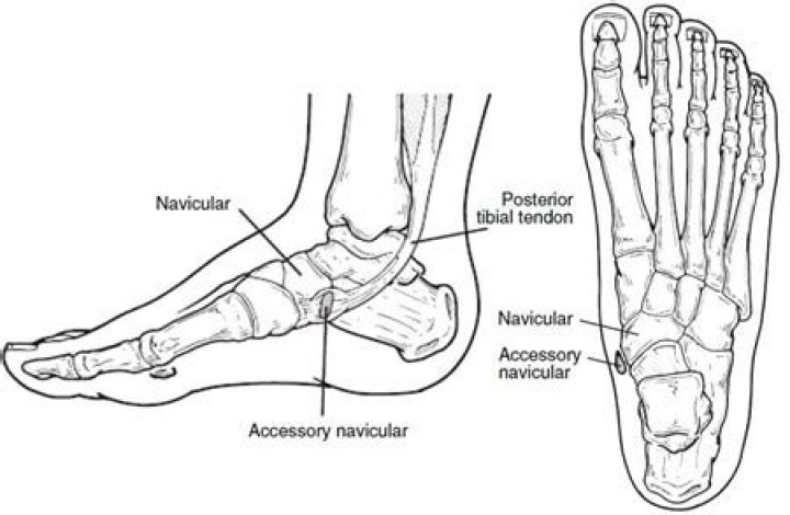 Where is the prehallux located?