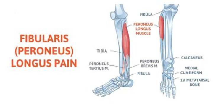 Why does my fibularis longus hurt?