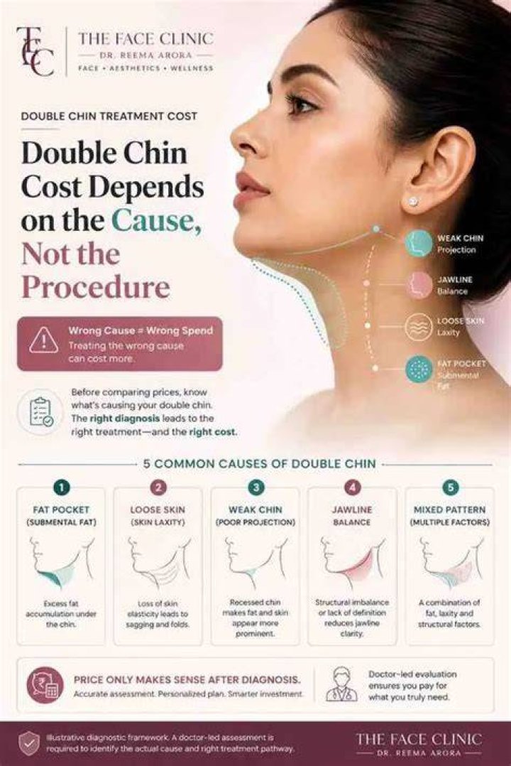 Why double chin comes?