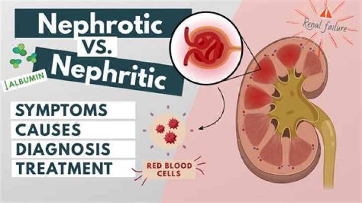 Why nephritic syndrome causes hypertension?